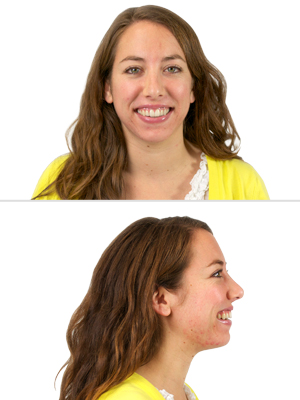 cystic acne laser treatment after